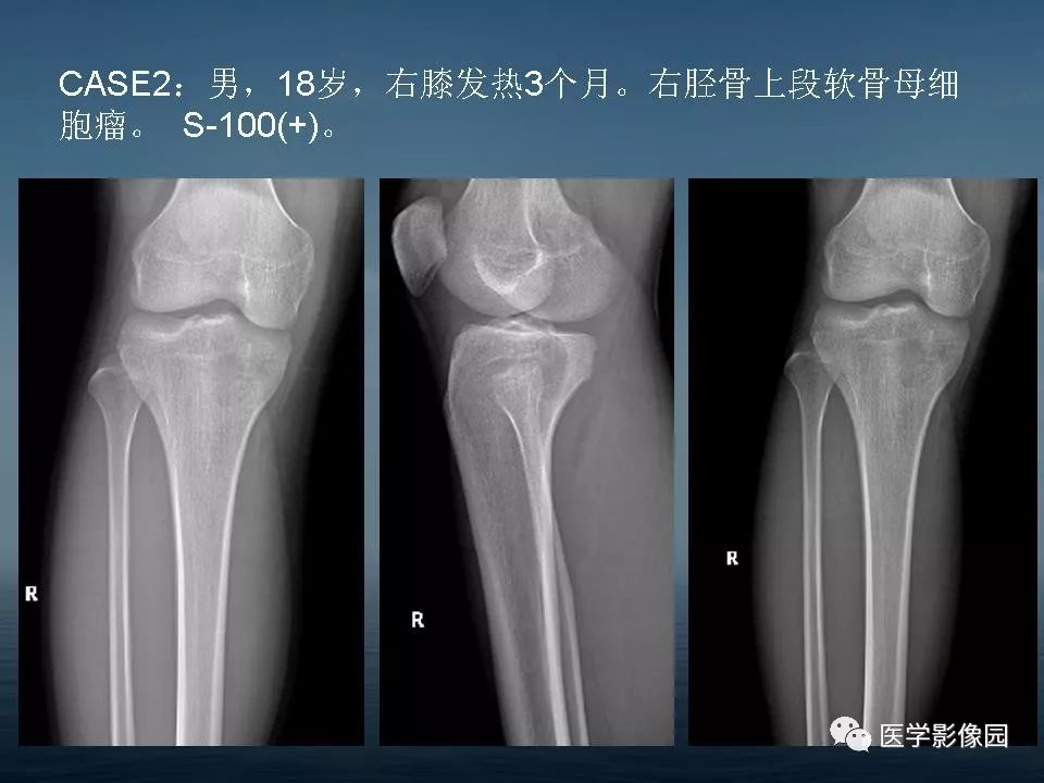 软骨母细胞瘤的影像诊断