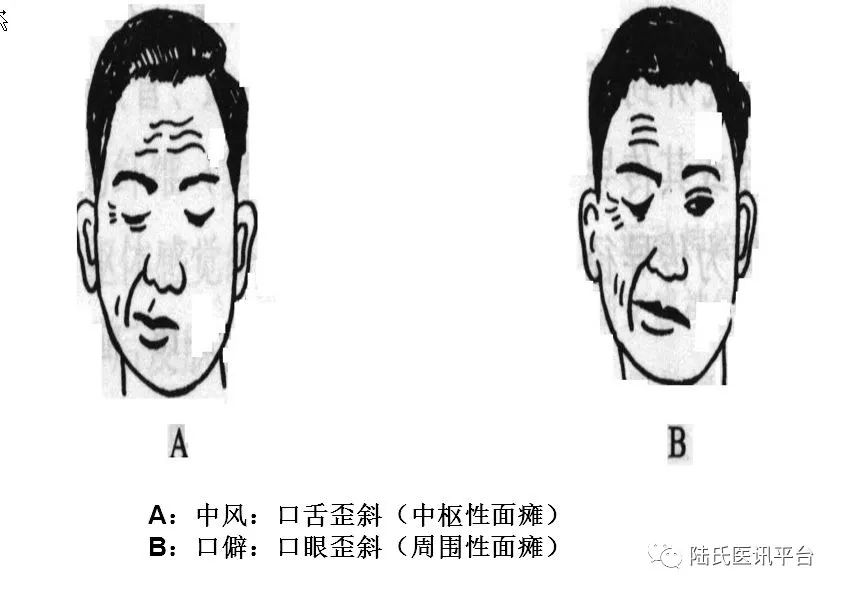 医学科普糟糕一觉醒来脸突然歪了是怎么回事