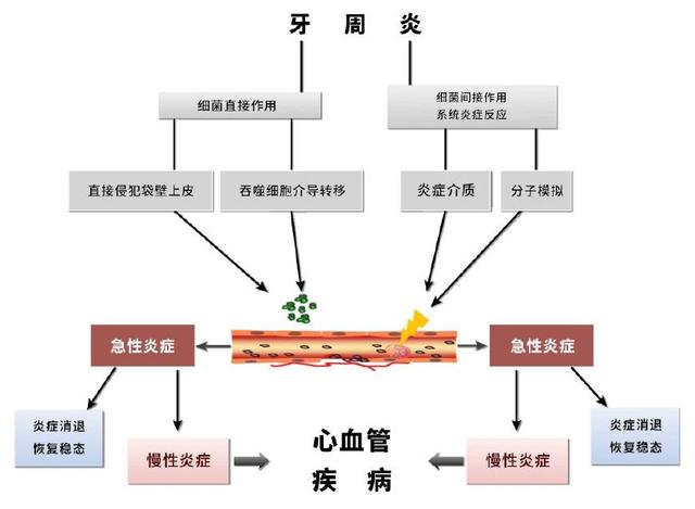 牙周炎與心血管疾病關聯的可能機制