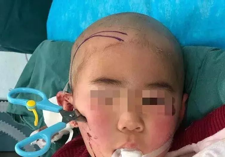 收治一名一岁三个月的患儿,孩子吃烤肠时摔倒,被竹签扎到,伤及眼睛