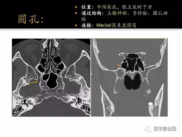 別再說難了,手把手教您學鼻腔鼻竇及顱底ct影像解剖丨影像天地