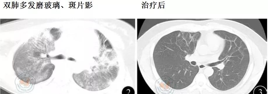 重庆医科大学附属第一医院,15例新型甲型h1n1流感肺炎患者胸部ct及x线