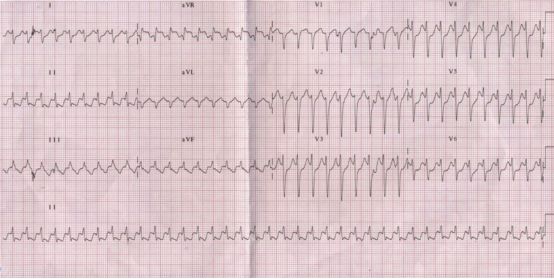 使用12导心电图(ecg;图1)显示阵发性室上性心动过速(psvt)