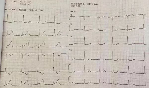 術後心電圖:竇性心律,Ⅱ,Ⅲ,avf導聯病理性q波,st段上抬0.