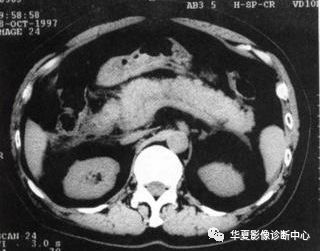 春節特刊急性胰腺炎的ct分級