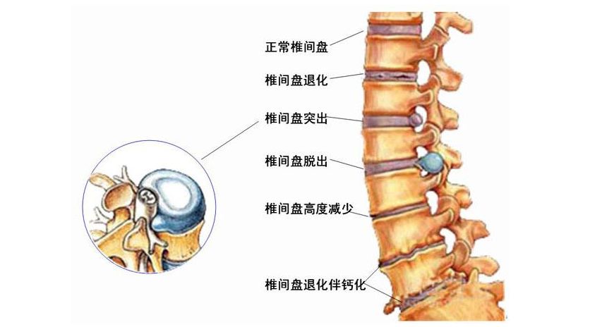 腰椎间盘突出分布图图片