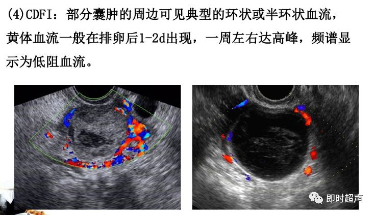 黄体囊肿图片图片