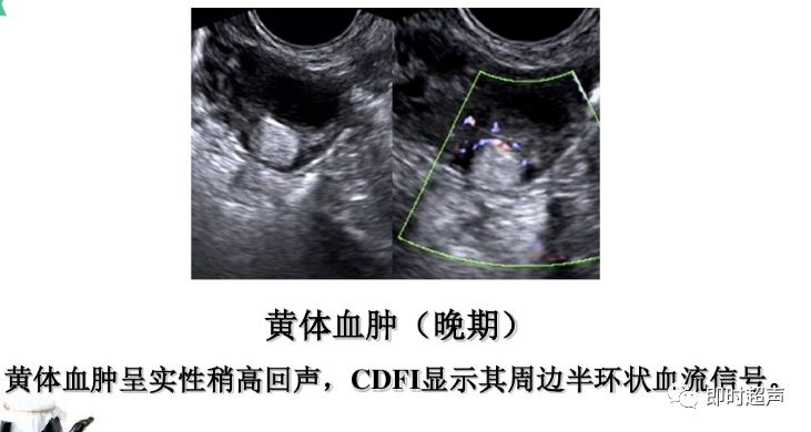 黄体囊肿的超声诊断