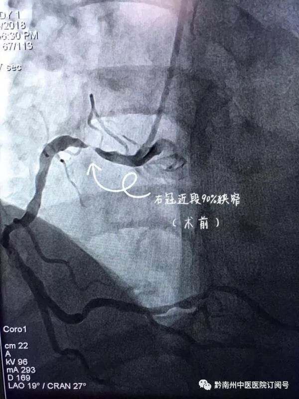 右冠近段90%狹窄(術前)術後我院心內科介入團隊僅成立8個多月,開展了