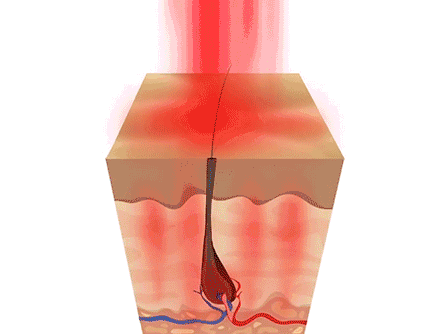 图为红光刺激毛囊,促使头发生长的模拟图