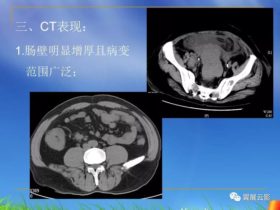 乙状结肠癌ct图片图片