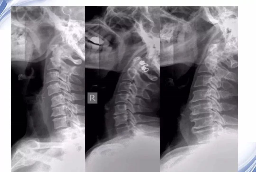 頸椎x線診斷技巧及其解讀1建議收藏
