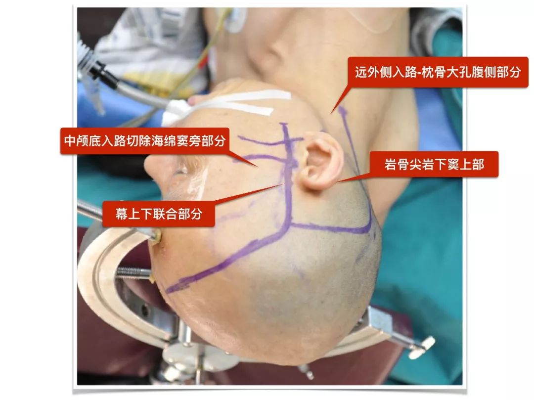 巖斜區腫瘤聯合入路切除術佟小光教授團隊2017手術病例分享top105