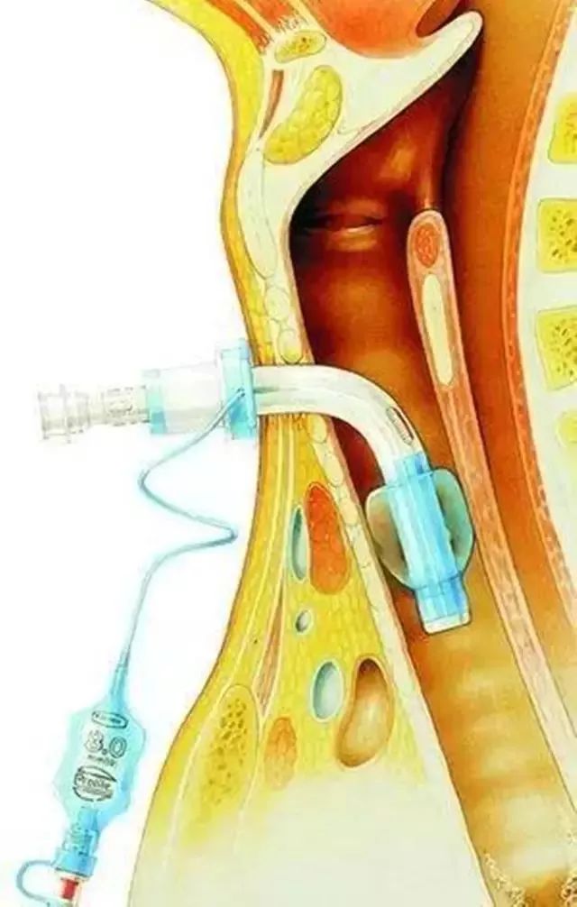 气管插管解剖示意图图片