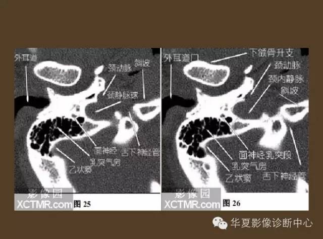 内耳ct解剖结构图图片