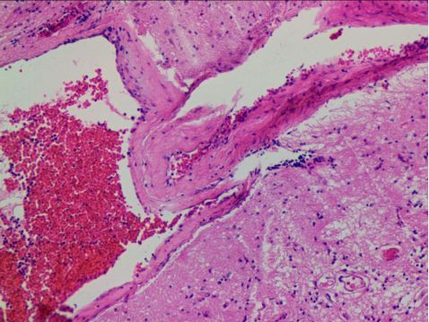 左颞枕)送检脑组织中可见畸形血管成分,部分血管内可见血栓形成及机化
