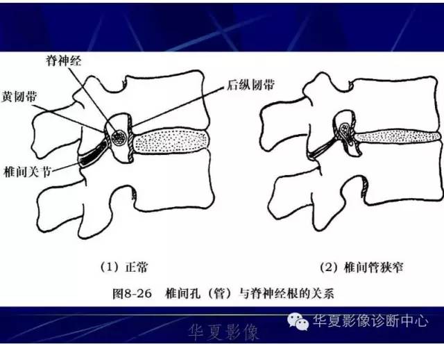 工作中每天都遇到詳細的腰椎解剖椎間盤突出膨出