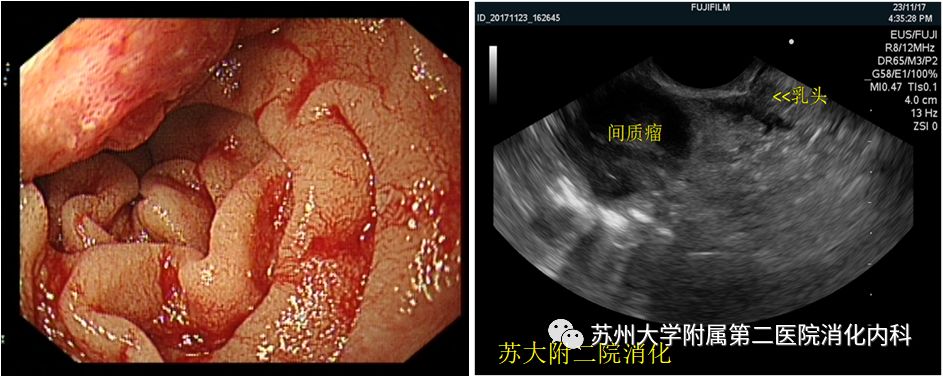 小小的十二指肠乳头里竟隐藏着大秘密?