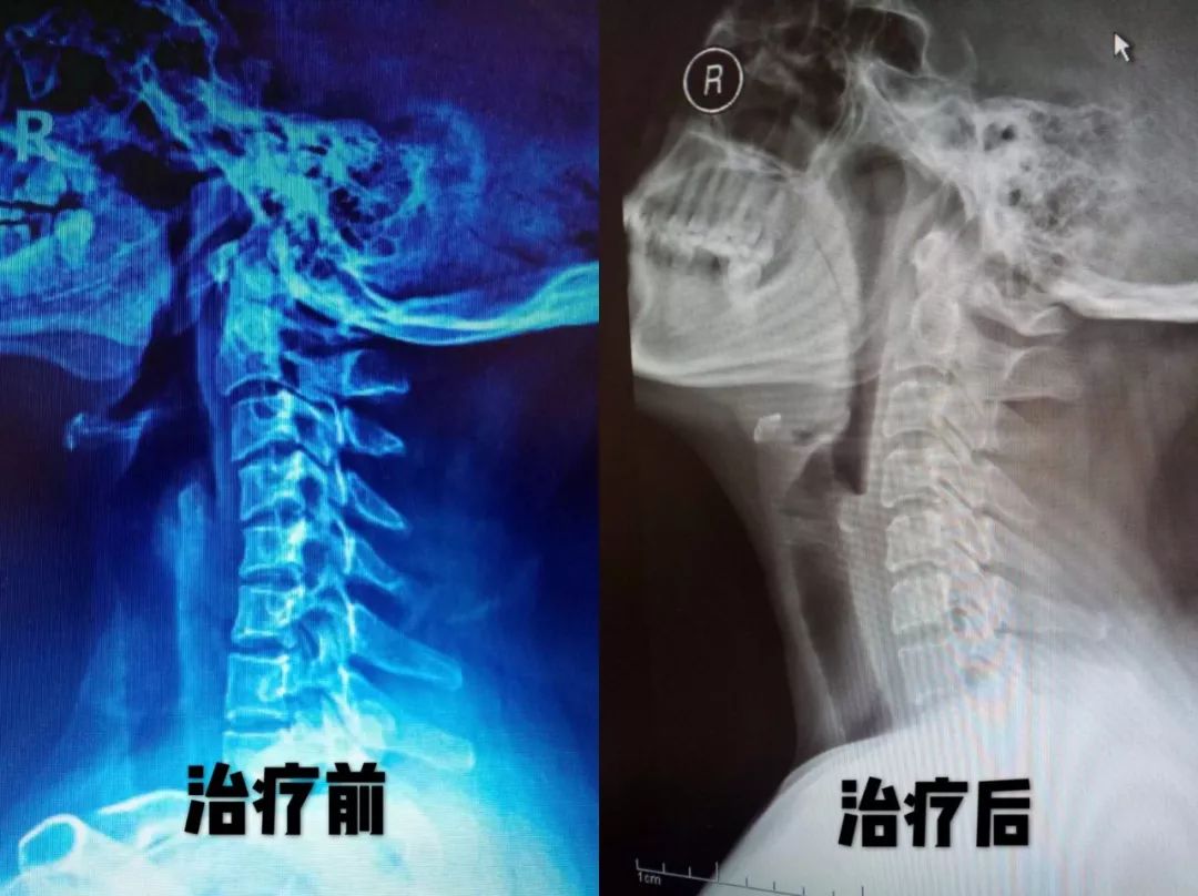 这三类人的颈椎最易变形这套颈椎康复操请收好