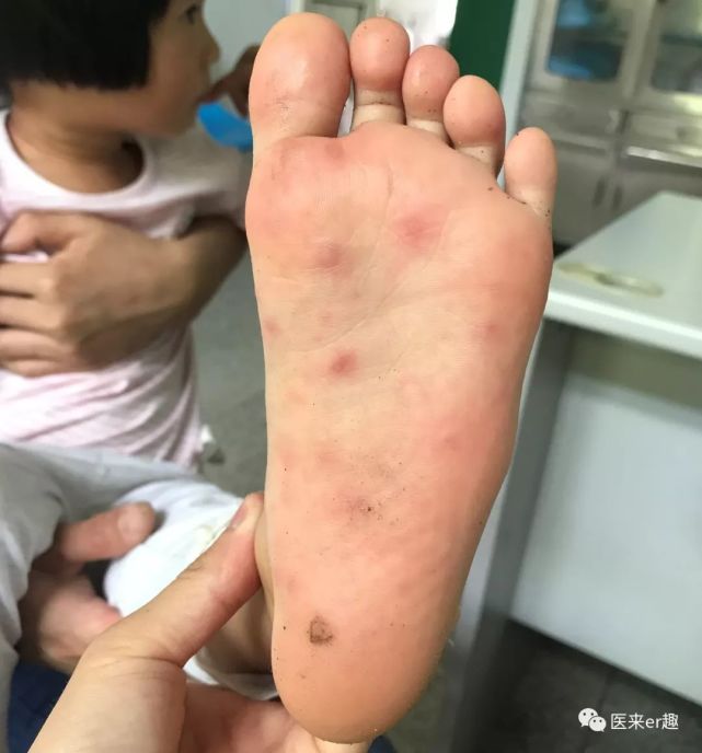 嬰幼兒手足口病很可怕嗎?