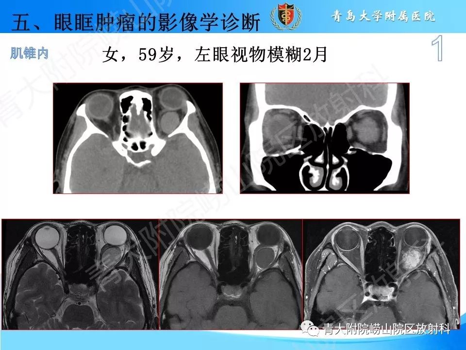 眼眶脂肪瘤图片