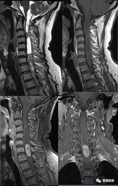 罕见丨髓内神经鞘瘤丨mri表现及鉴别诊断