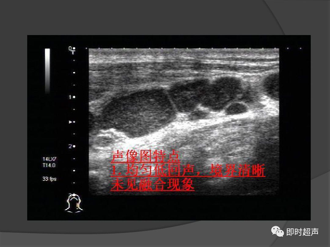 常见淋巴结疾病及其超声表现