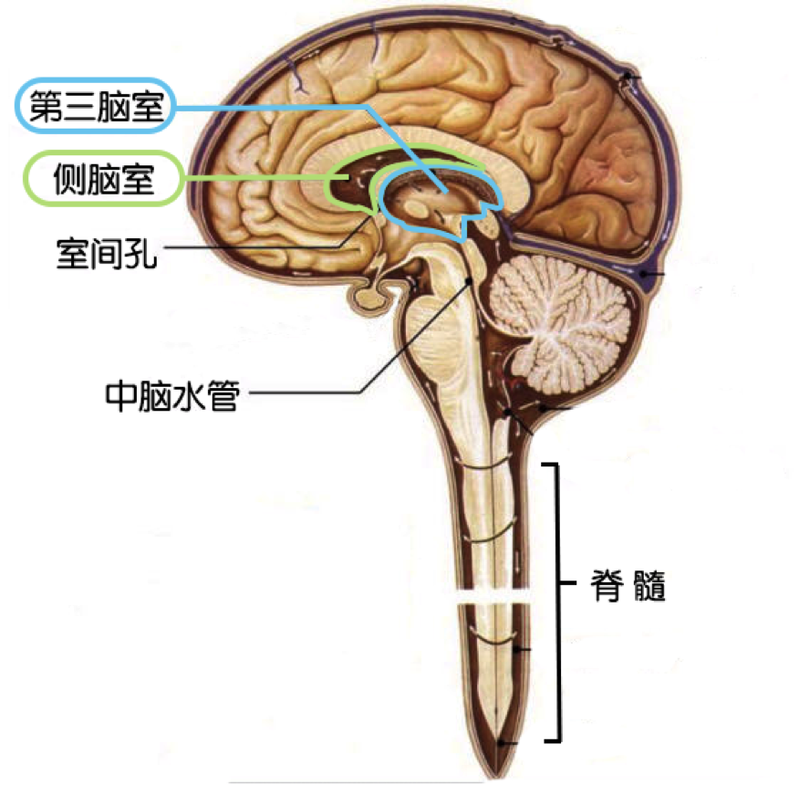 侧脑室增宽图片