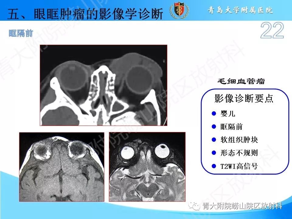 眼眶脂肪瘤图片