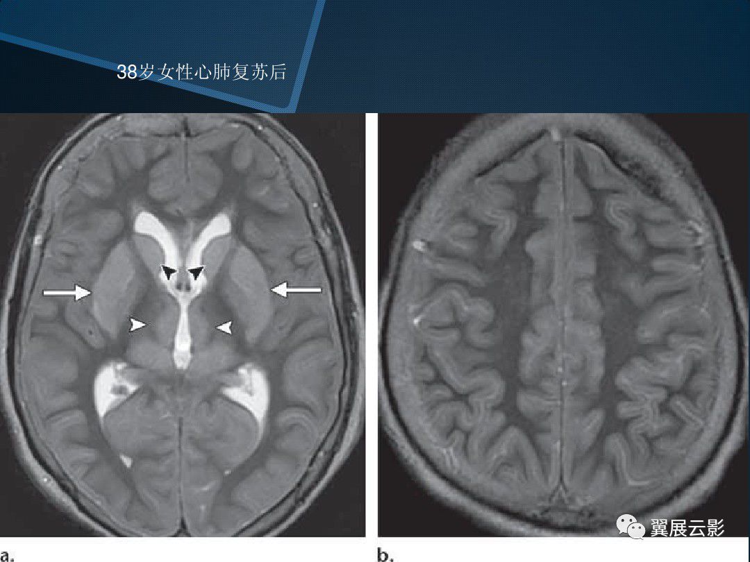 基底节区丘脑区对称性病变总结