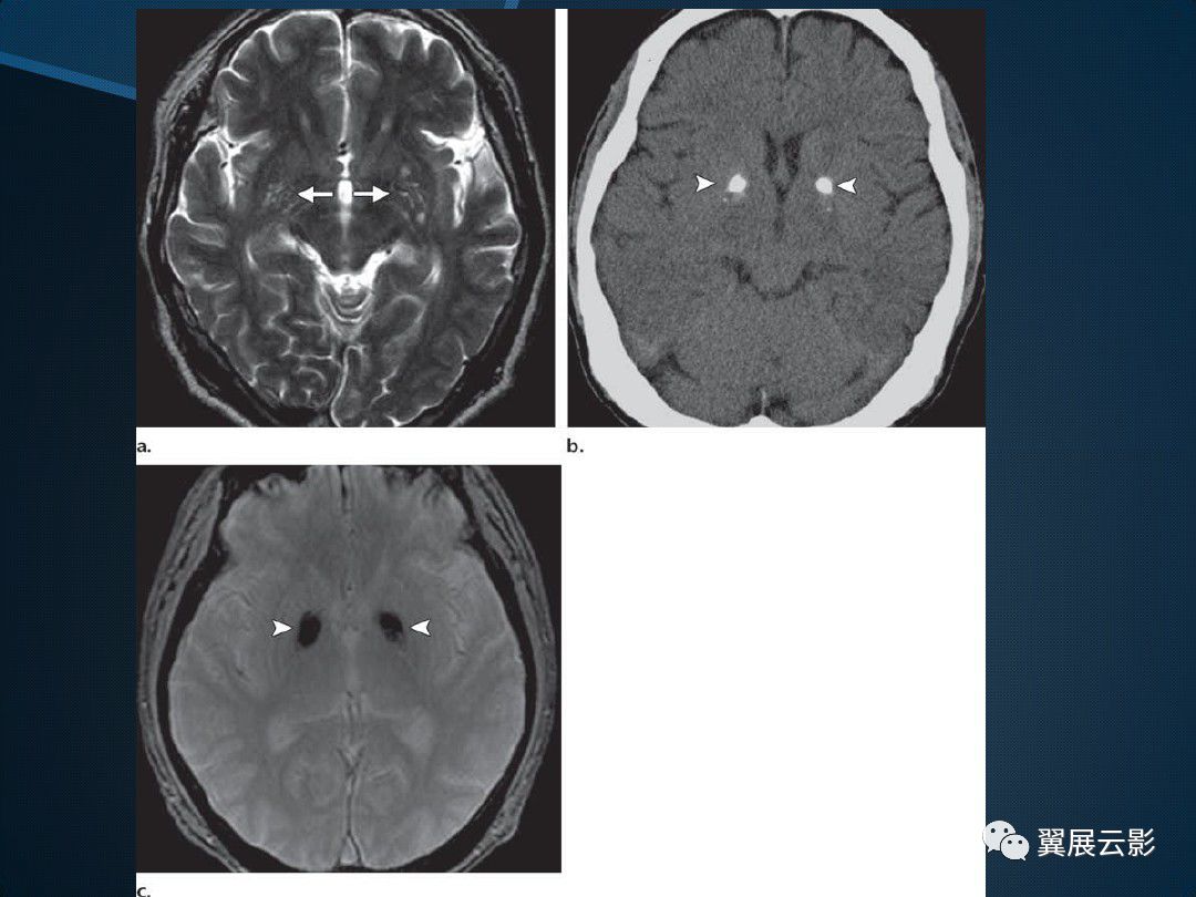 基底节区丘脑区对称性病变总结