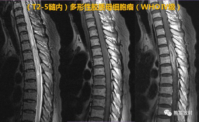 神经根鞘囊肿影像图片