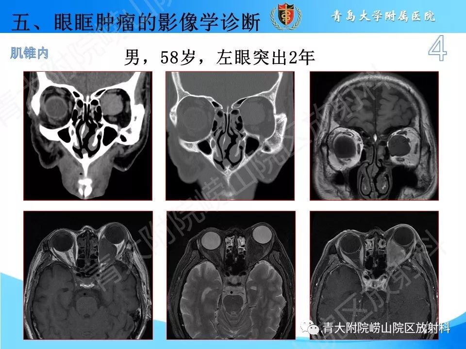 眼眶脂肪瘤图片