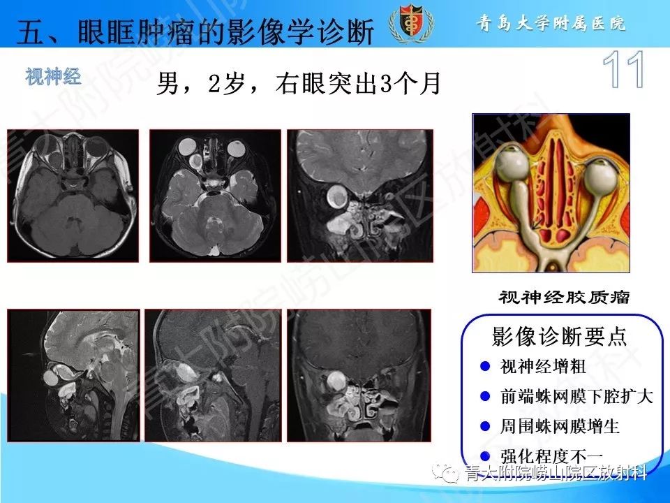 眼眶肿瘤的影像诊断