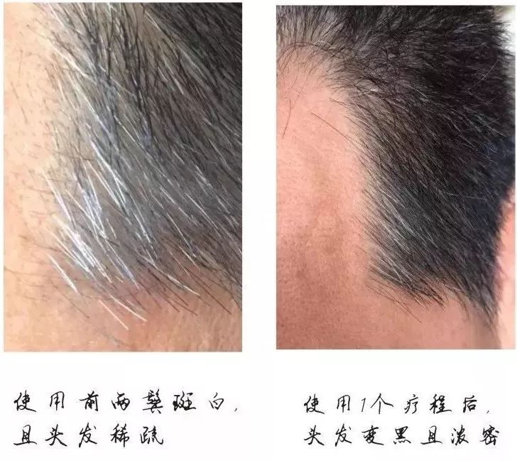客户案例一:在使用前两鬓白发且稀疏,一个疗程后,白头发减少而且头发