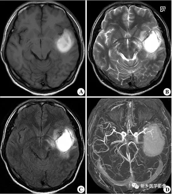 脑出血磁共振图片图片