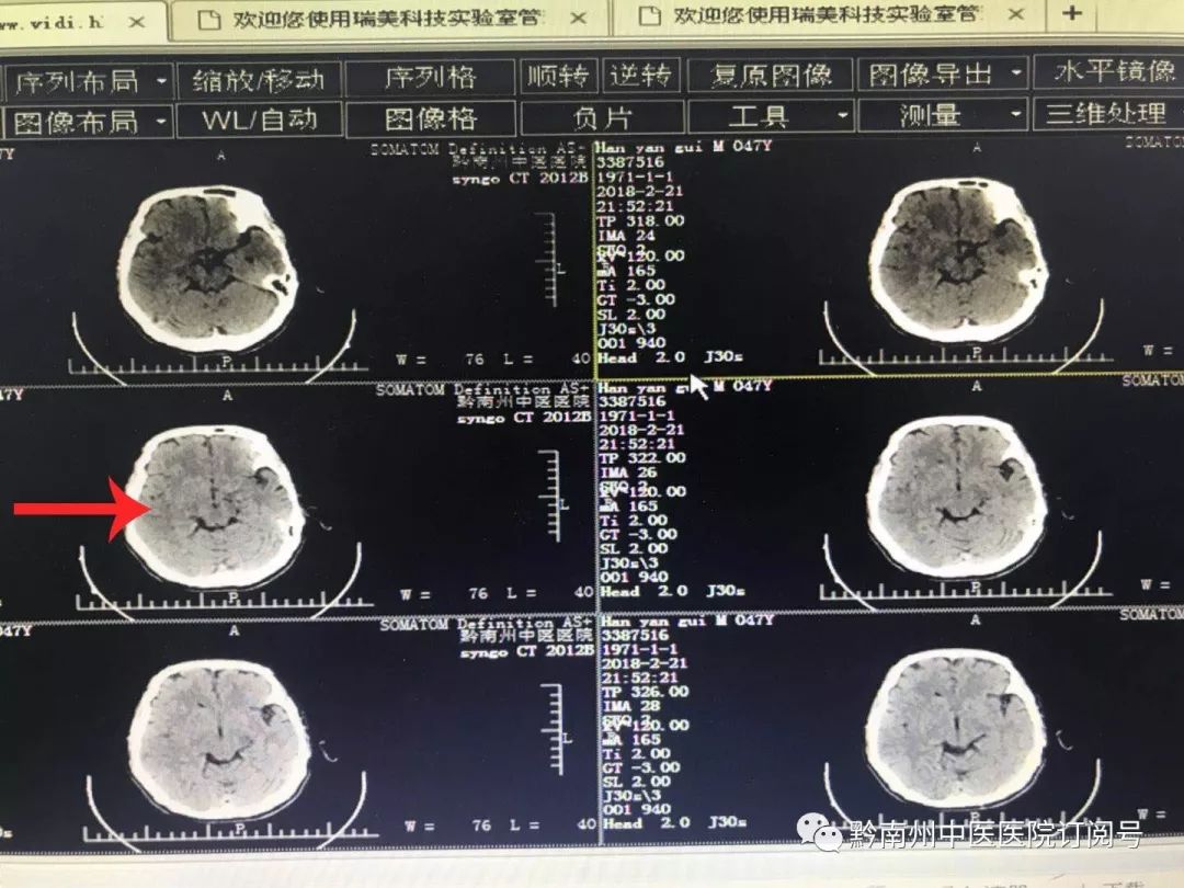 術前頭顱ct:在動脈溶栓時間窗內,外一科醫護團隊快速積極作好術前準備