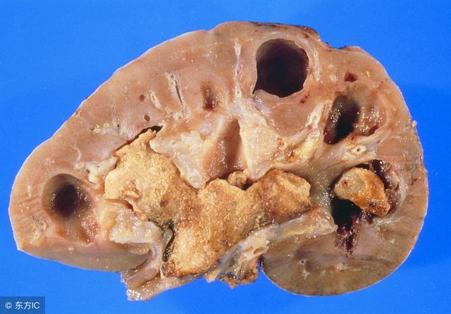 腎結石只是小病那你就錯了引發的危害足夠致命