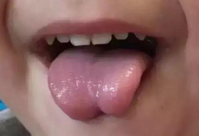 舌头筋短图片