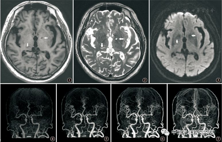 圖1～3頭顱mri平掃t1wi,t2wi和dwi,可見雙側基底節區多發腔隙,t1wi