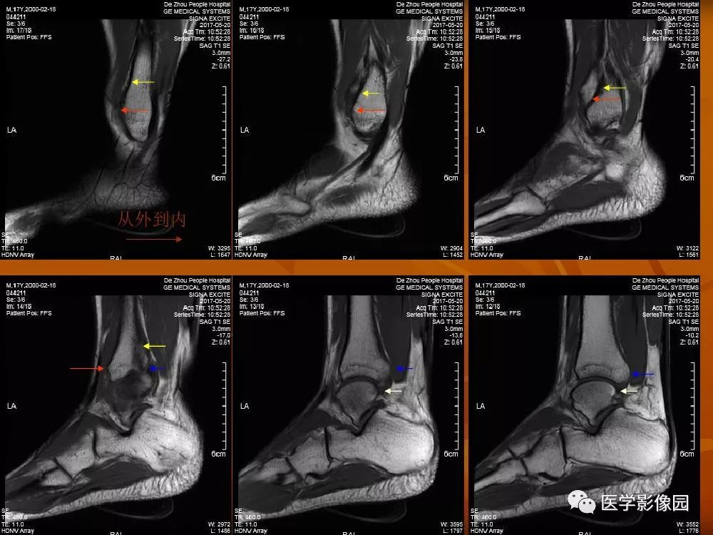 踝关节韧带的解剖及影像表现丨影像天地