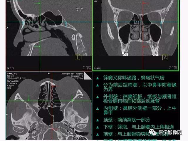 副鼻窦正常CT解剖图片