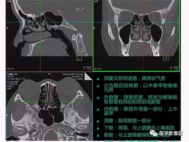 有图有笔记之鼻腔副鼻窦常见病变影像诊断丨影像天地