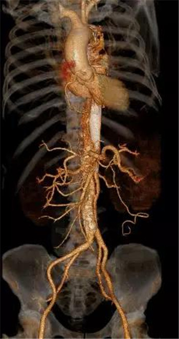 鄭州大學五附院血管外科治療一例複雜慢性胸主動脈瘤夾層--為患者解除