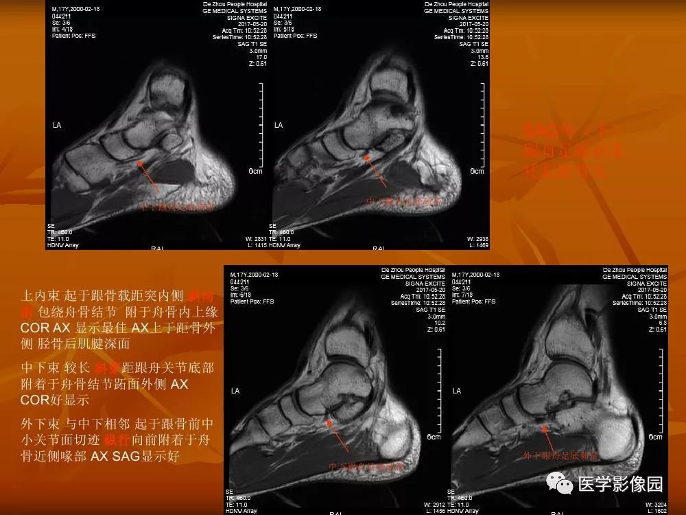 踝关节韧带的解剖及影像表现丨影像天地