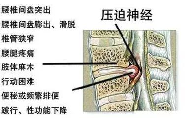 腰椎滑脱是怎么造成的图片