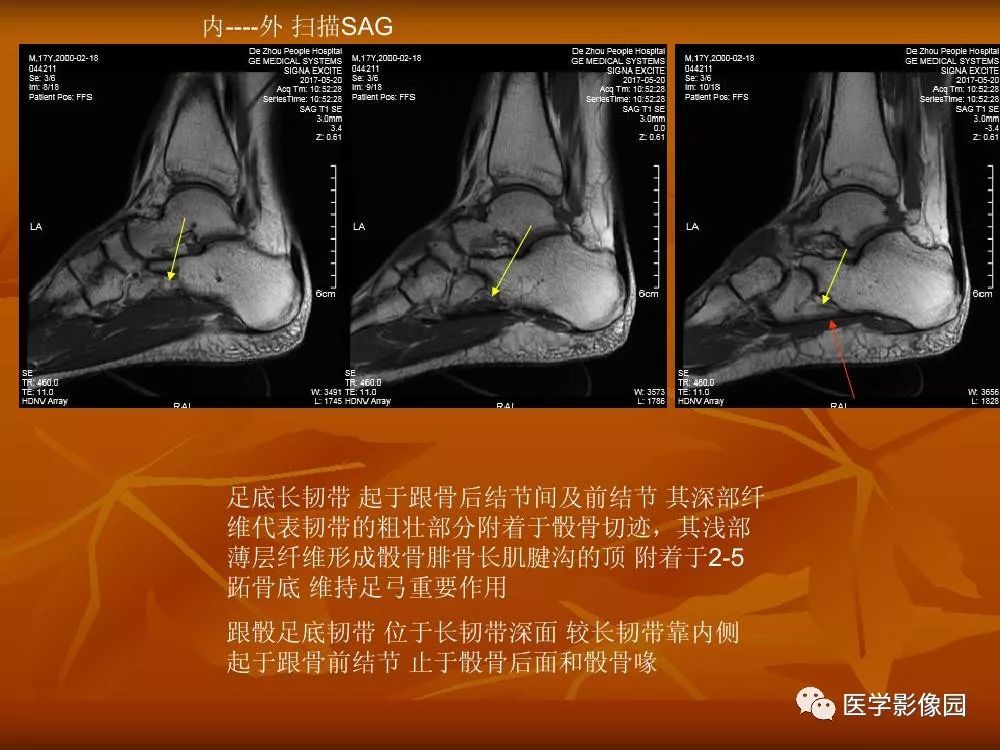 踝关节韧带的解剖及影像表现丨影像天地