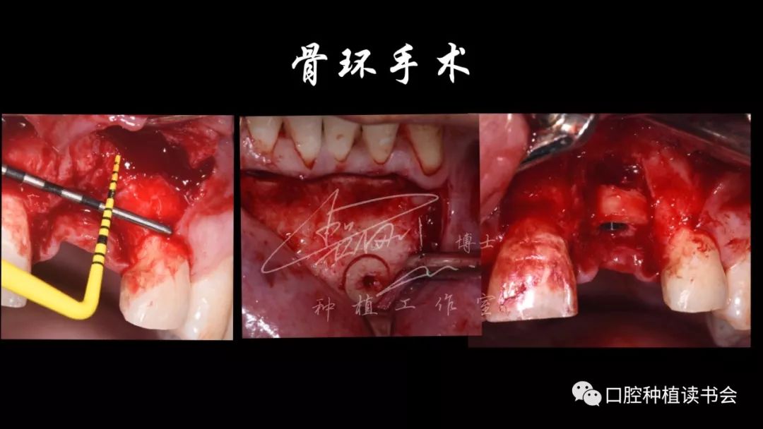 新春献礼种植牙生物学宽度的思考和临床应用中