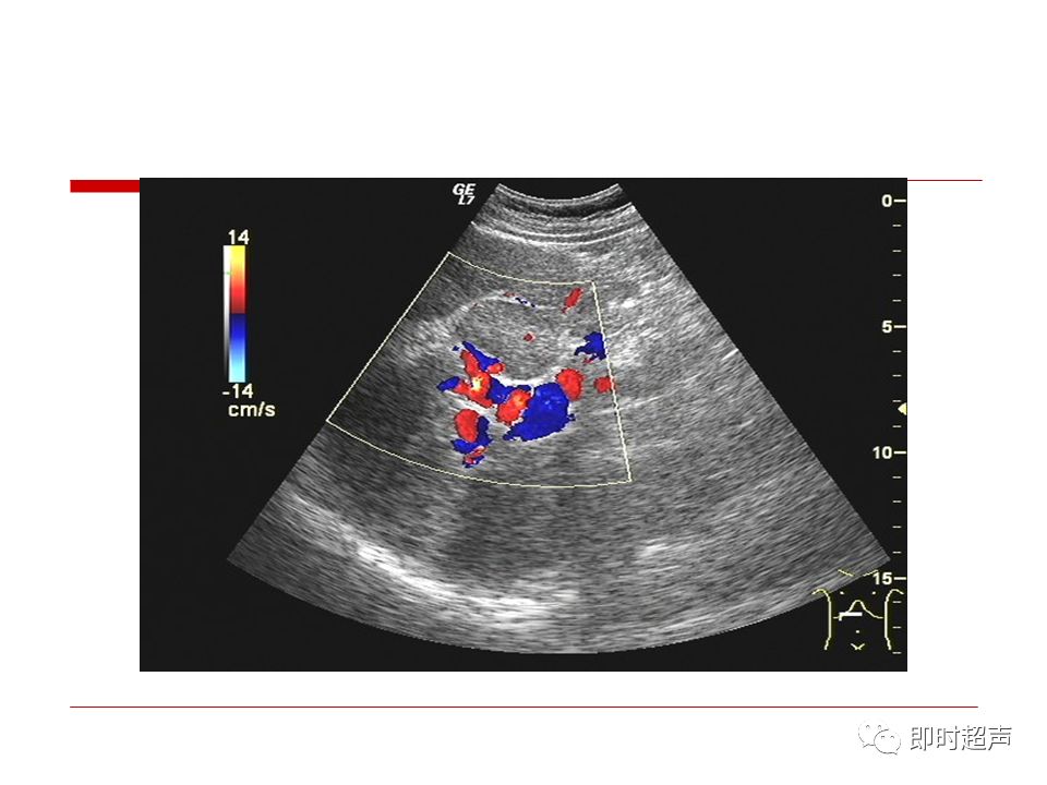 肝臟解剖及超聲表現