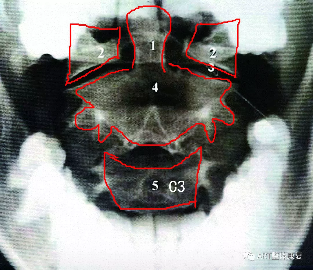 1,第6颈椎的椎体 2,气管阴影之缘 3,椎体 4,横突 4,5钩椎关 节不对称)